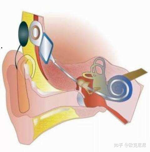 最新听力恢复技术解析与观点阐述，创新科技重塑听力世界